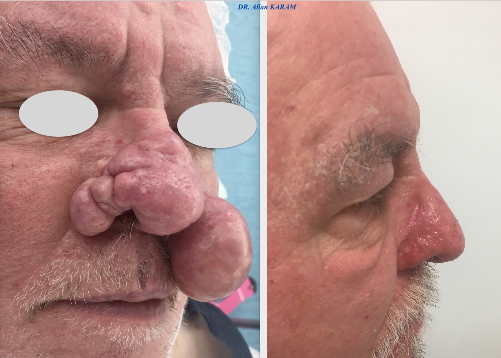 rhinophyma