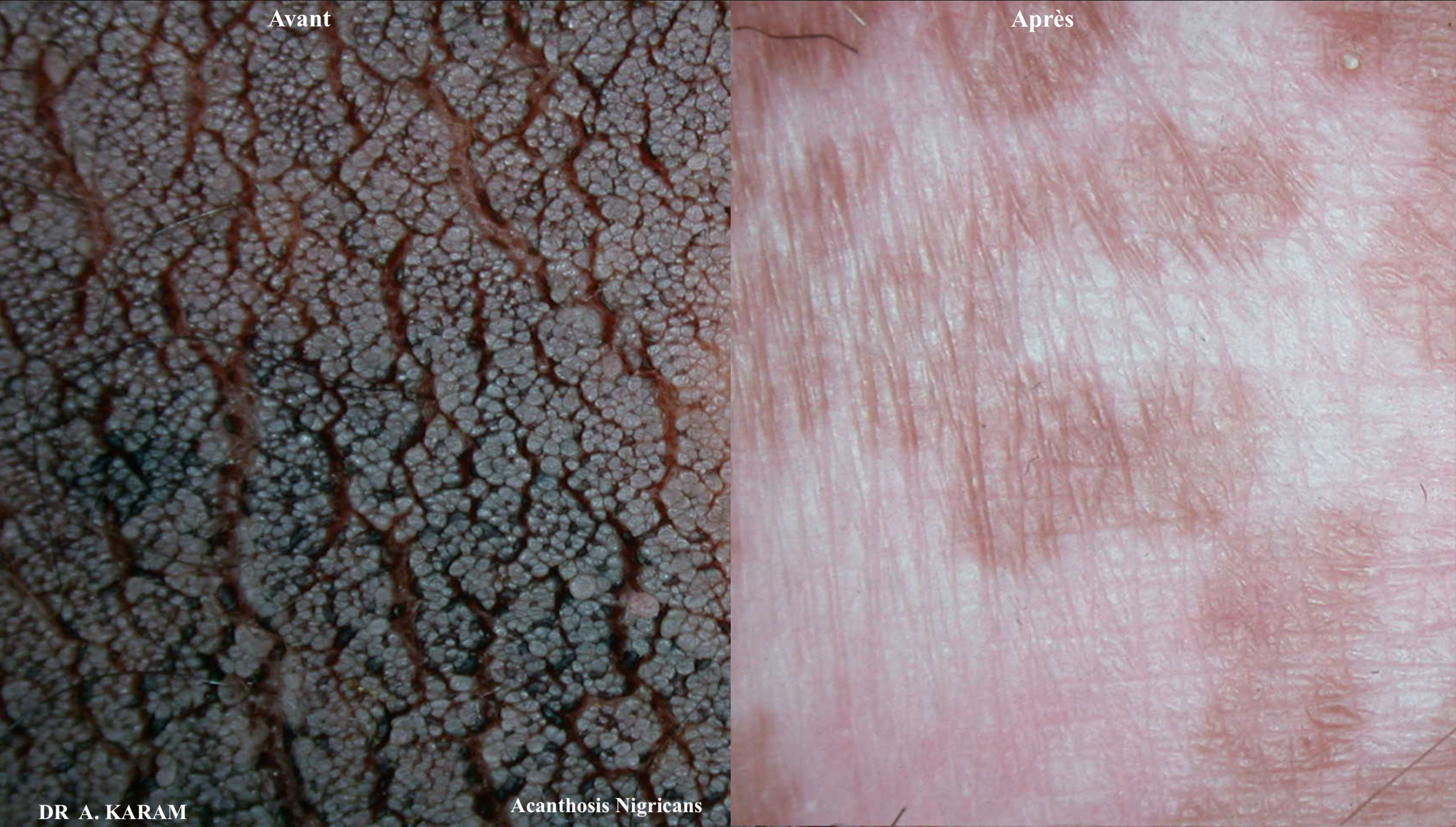 acanthosis